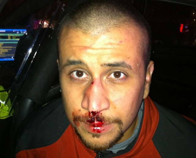 George Zimmerman broken nose